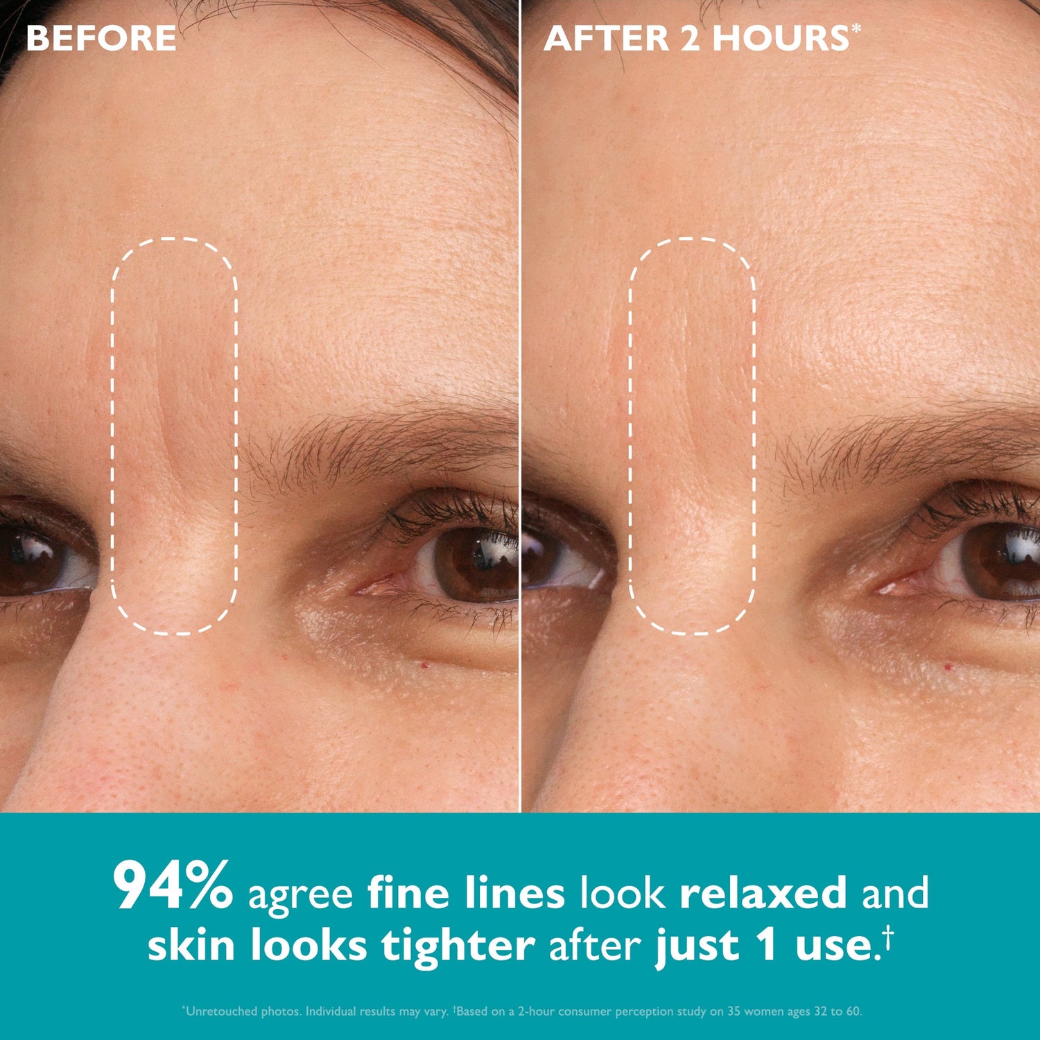 Neanes visible under-eye results